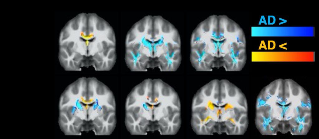 Comparison between healthy controls and AD subjects for standard (top) and free-water-corrected (bottom) dMRI metrics