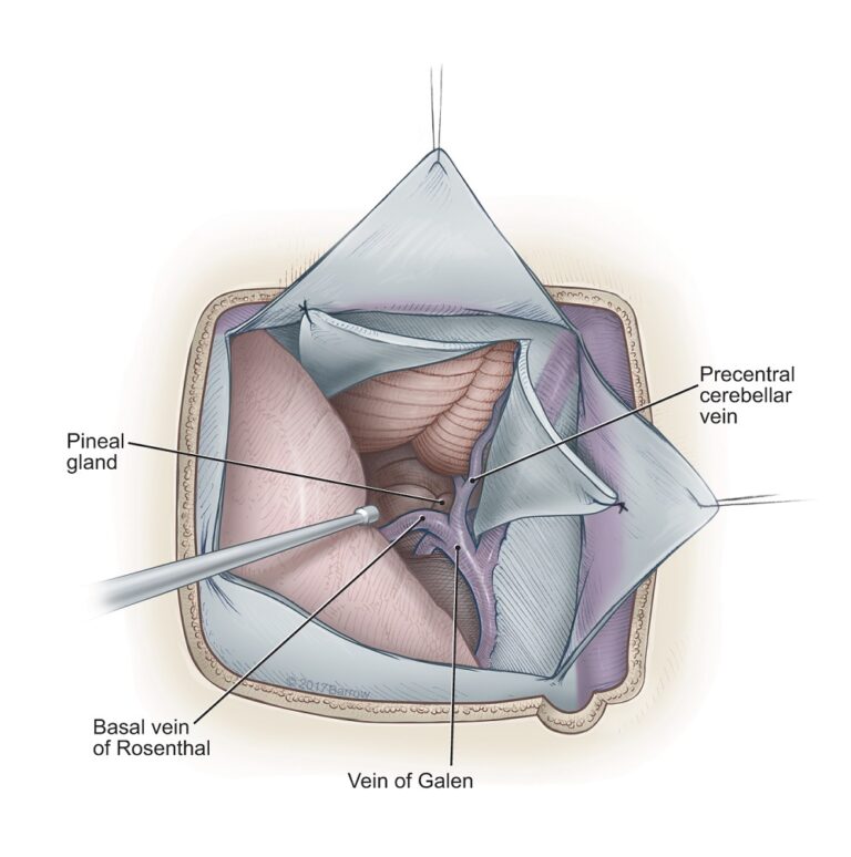Pineal Cyst Symptoms, Diagnosis, Treatment