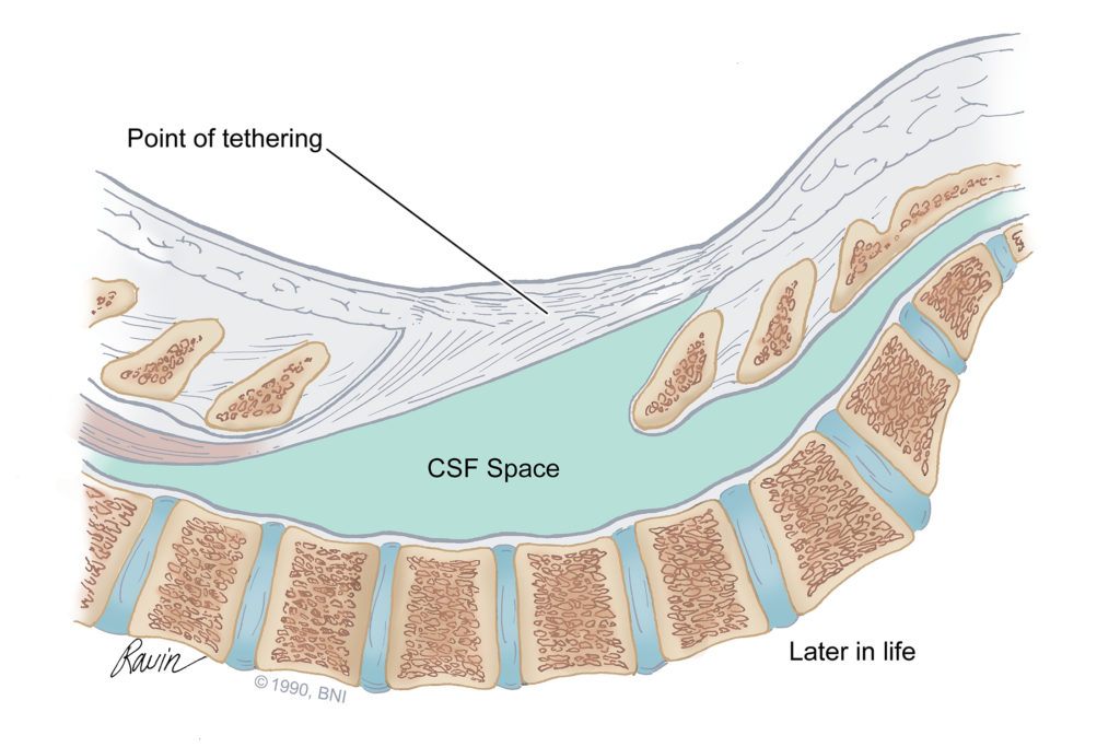 illustration of tethered spinal cord
