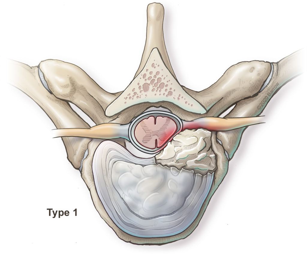 illustration showing a herniated thoracic disc compressing the spinal cord and nerve root exiting the thoracic spinal cord